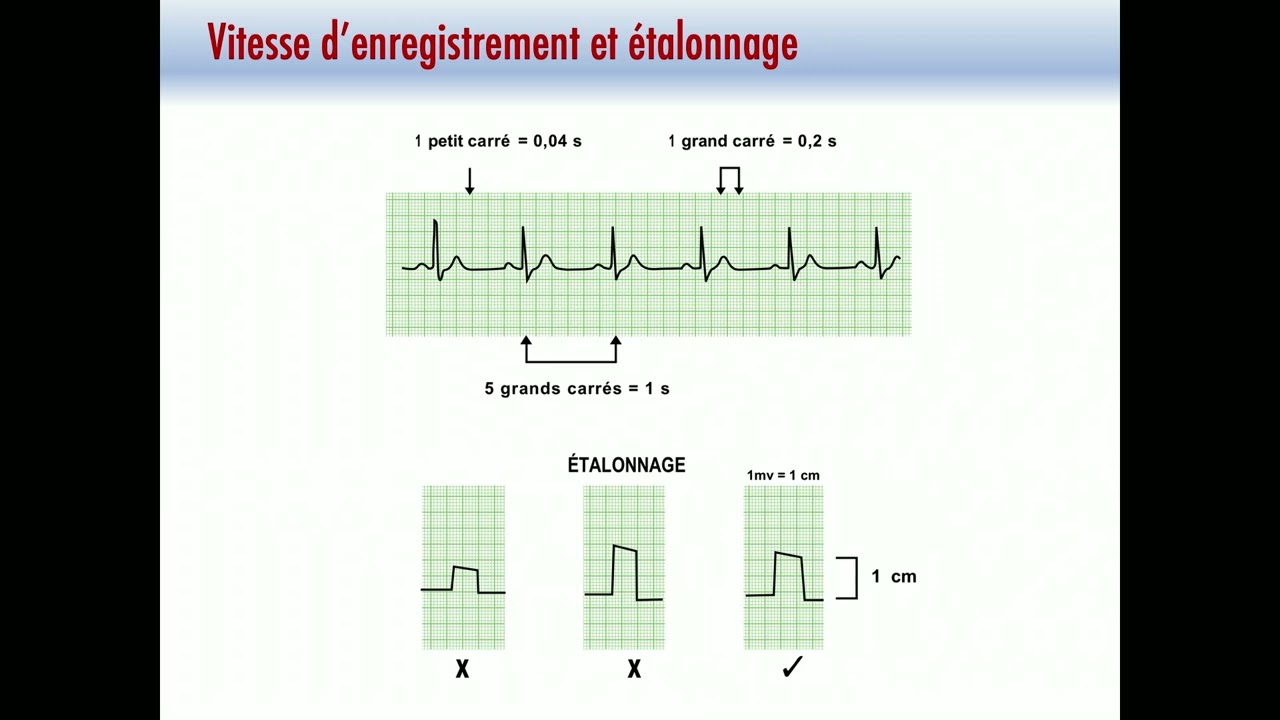L’ECG pathologique Pr Zainab Raissouni MG Maroc 2025